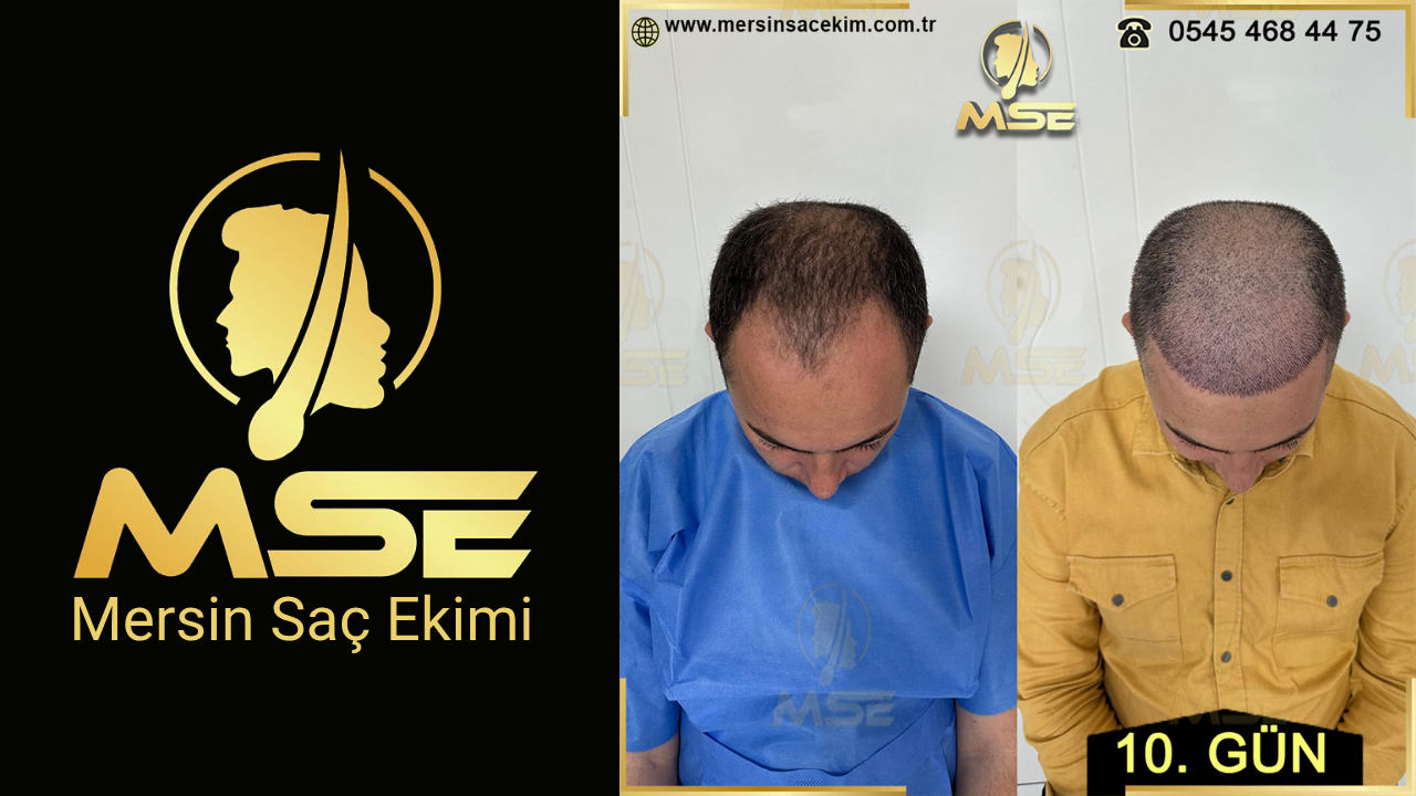 MERSİN SAÇ EKİMİ